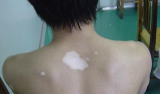 寻常型银屑病的原因有哪些