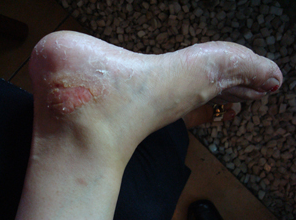 银屑病怎么治疗最好