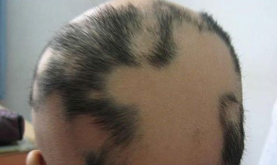 斑秃的治疗要怎么做