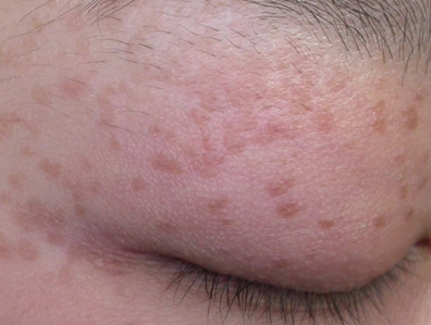 扁平疣不断加重的原因是什么