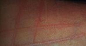 荨麻疹治疗有哪些好方法