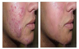 治疗青春痘如何避免误区