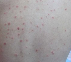 牛皮癣治疗复发