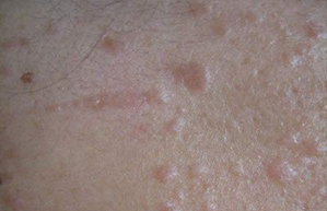 扁平疣患者生活中要注意什么