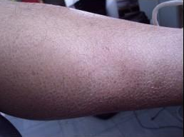 治疗鱼鳞病的原则是什么