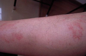 夏季皮炎有哪些症状