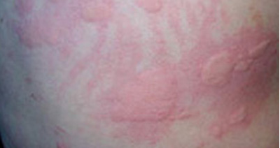 诱发荨麻疹的病因通常是哪些