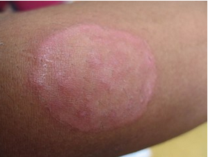 到底体癣是如何引起的