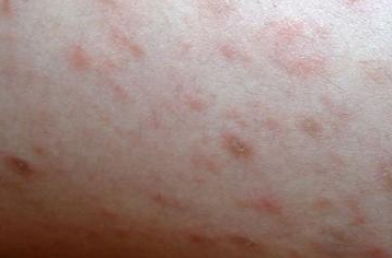 脓疱型银屑病能治好吗