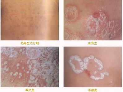 老年人银屑病如何治疗
