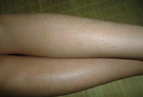 鱼鳞病能治痊愈吗