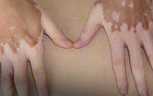 如何正确认识理解白癜风