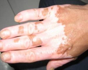 白癜风带来的影响有哪些