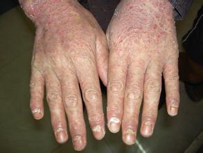 导致银屑病产生的原因有哪些