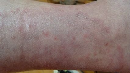 银屑病患者日常保健