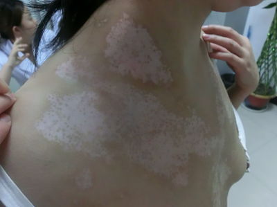 男性白癜风的危害有哪些