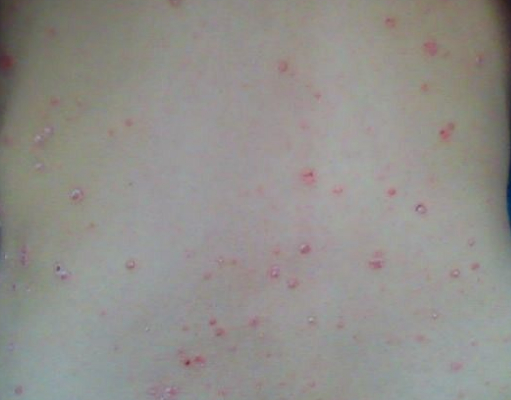 脓疱型牛皮癣治疗方式