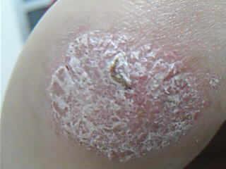 为什么会得牛皮癣呢