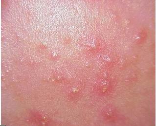 青春痘如何预防才不会留下痘坑痘印?