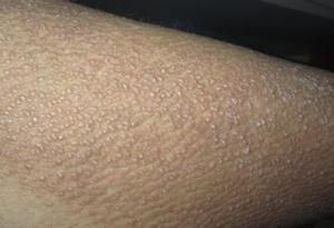 得了银屑病的病因都有哪些