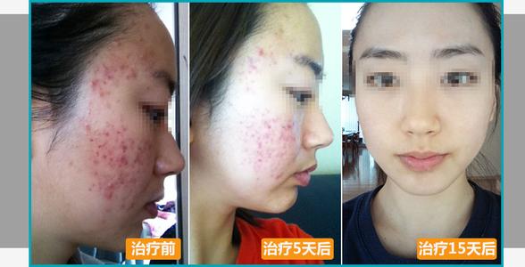 扬州治疗青春痘多少钱