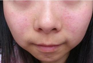 脸上皮肤瘙痒图片